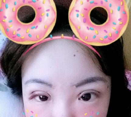 雙眼皮恢復(fù)過程分享