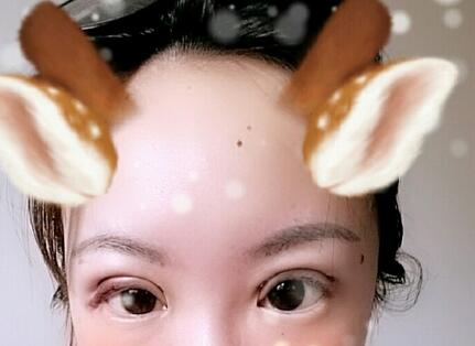 雙眼皮恢復(fù)過程分享