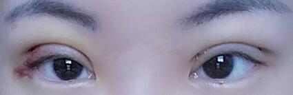 雙眼皮恢復(fù)過程分享