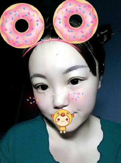 雙眼皮恢復(fù)過程分享