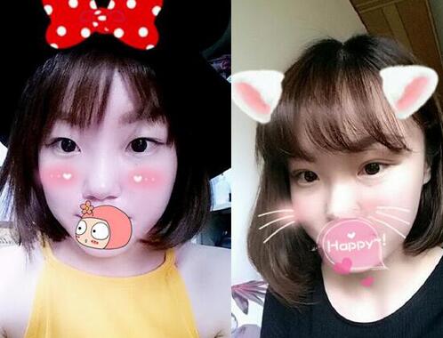 雙眼皮恢復(fù)過程分享