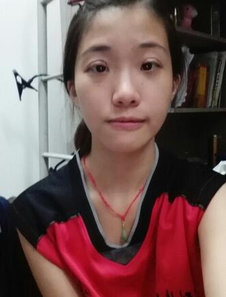 雙眼皮15天恢復記錄