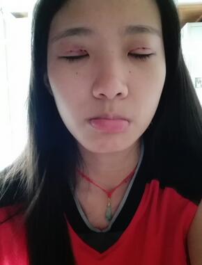 雙眼皮15天恢復記錄