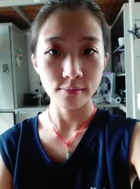 雙眼皮15天恢復記錄