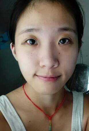 雙眼皮15天恢復記錄