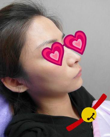 Misko隆鼻讓我鼻子變得挺拔嬌俏無(wú)壓力