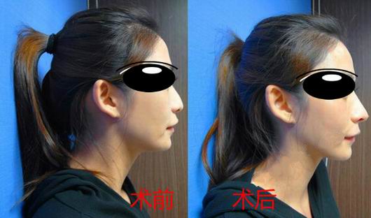 Misko隆鼻讓我鼻子變得挺拔嬌俏無(wú)壓力