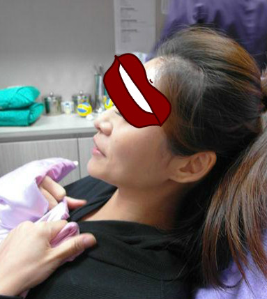 Misko隆鼻讓我鼻子變得挺拔嬌俏無(wú)壓力