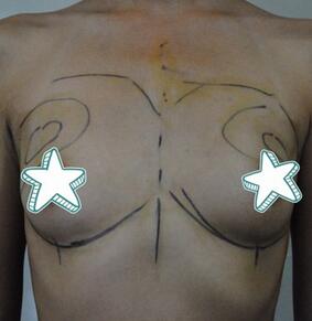 成都艾米麗自體脂肪豐胸前后對(duì)比