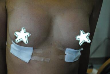 成都艾米麗自體脂肪豐胸前后對(duì)比