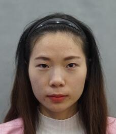 長沙美之峰重瞼+開眼角恢復過程圖