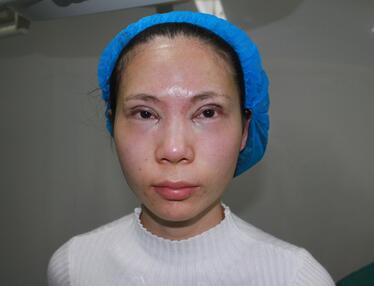 長沙美之峰重瞼+開眼角恢復過程圖