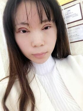 長沙美之峰重瞼+開眼角恢復過程圖