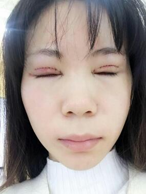 長沙美之峰重瞼+開眼角恢復過程圖