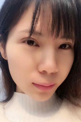 長沙美之峰重瞼+開眼角恢復過程圖