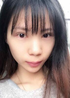 長沙美之峰重瞼+開眼角恢復過程圖