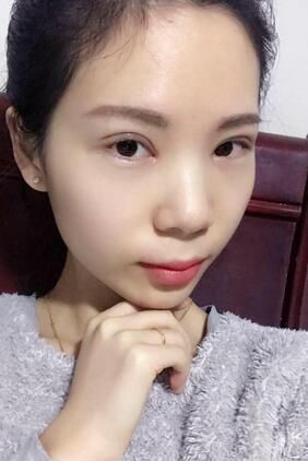 長沙美之峰重瞼+開眼角恢復過程圖