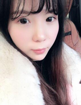 長沙美之峰重瞼+開眼角恢復過程圖