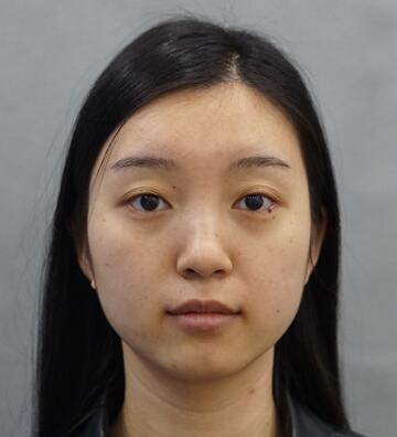 長沙美之峰割雙眼皮3個月了