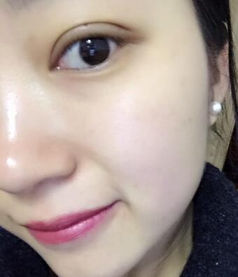 長沙美之峰割雙眼皮3個月了