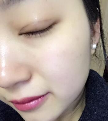 長沙美之峰割雙眼皮3個月了