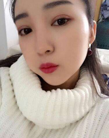 長沙美之峰割雙眼皮3個月了