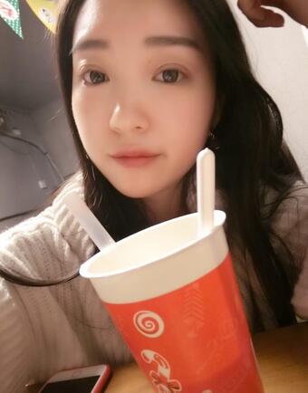 長沙美之峰割雙眼皮3個月了