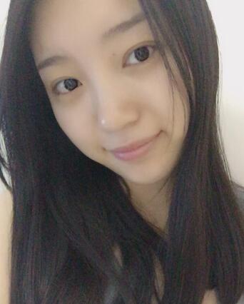 長沙美之峰割雙眼皮3個月了