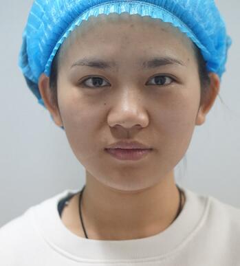 長沙美之峰假體隆鼻恢復日記