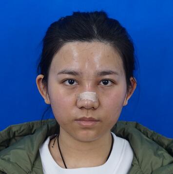 長沙美之峰假體隆鼻恢復日記