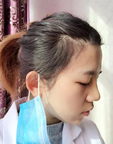 長沙美之峰假體隆鼻恢復日記