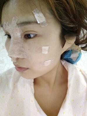 長沙美之峰隆鼻整形手術(shù)恢復(fù)日記圖