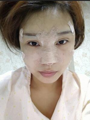 長沙美之峰隆鼻整形手術(shù)恢復(fù)日記圖