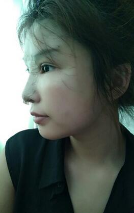 長沙美之峰隆鼻整形手術(shù)恢復(fù)日記圖