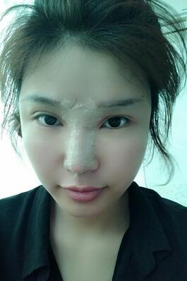 長沙美之峰隆鼻整形手術(shù)恢復(fù)日記圖