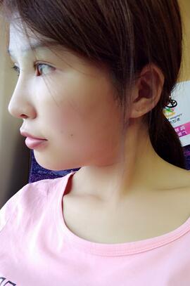 長沙美之峰隆鼻整形手術(shù)恢復(fù)日記圖