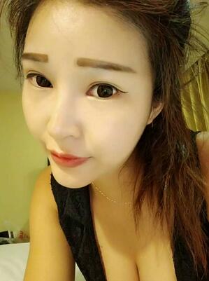 長沙美之峰隆鼻整形手術(shù)恢復(fù)日記圖