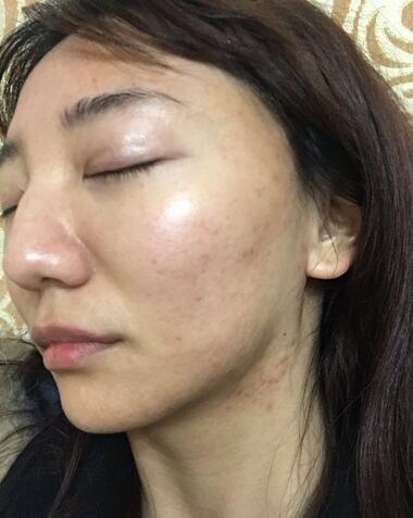 北京歐華去痘坑痘印兩個(gè)月