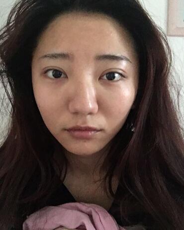 北京歐華去痘坑痘印兩個(gè)月