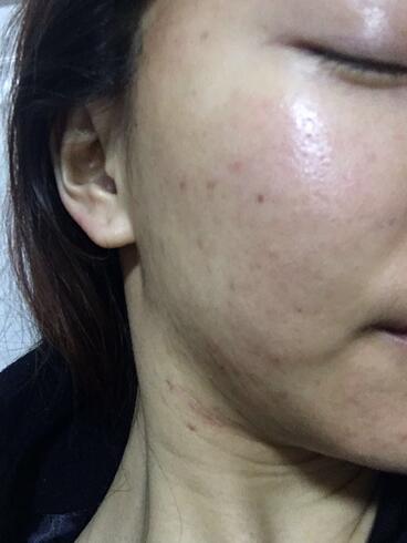 北京歐華去痘坑痘印兩個(gè)月