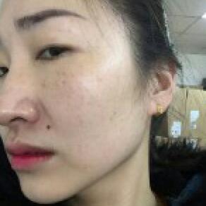 激光祛斑20天后的圖片 北京歐華王芳