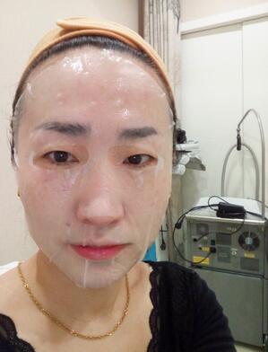 激光祛斑20天后的圖片 北京歐華王芳