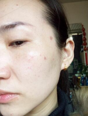 激光祛斑20天后的圖片 北京歐華王芳