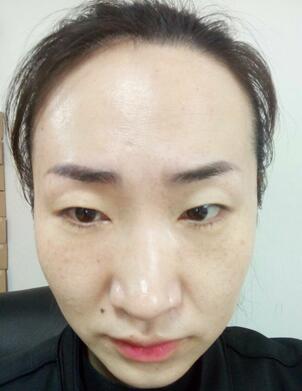 激光祛斑20天后的圖片 北京歐華王芳