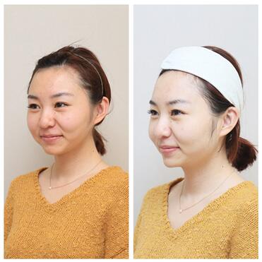 我做射頻緊膚經(jīng)歷 醫(yī)師：北京歐華王芳