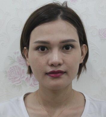 玻尿酸豐太陽(yáng)7天果圖 愛(ài)悅麗格豐太陽(yáng)穴一個(gè)月啦~