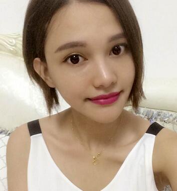 玻尿酸豐太陽(yáng)7天果圖 愛(ài)悅麗格豐太陽(yáng)穴一個(gè)月啦~