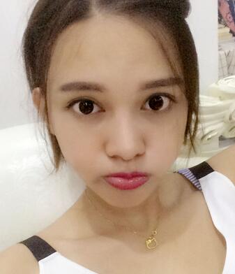 玻尿酸豐太陽(yáng)7天果圖 愛(ài)悅麗格豐太陽(yáng)穴一個(gè)月啦~