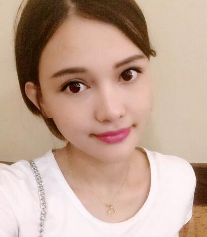 玻尿酸豐太陽(yáng)7天果圖 愛(ài)悅麗格豐太陽(yáng)穴一個(gè)月啦~