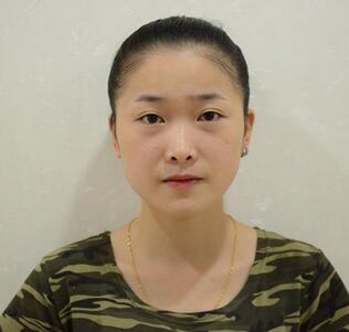 愛悅麗格玻尿酸豐蘋果肌、豐下巴、隆鼻